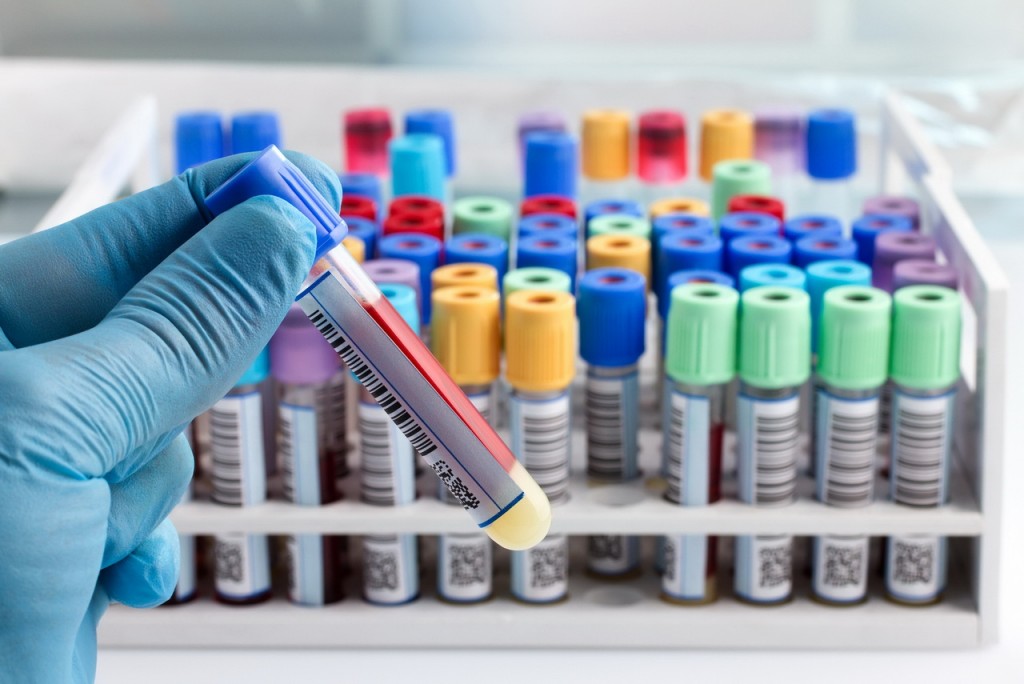 Более полутора тысяч новых случаев Covid-19 выявлено в Молдове