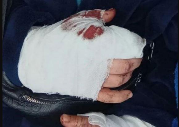 В Тирасполе мужчина взорвал фейерверк в руках и получил ожоги кистей